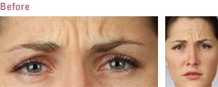 botox1.jpg
