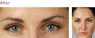 botox2.jpg