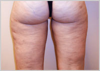 mesotherapy.jpg